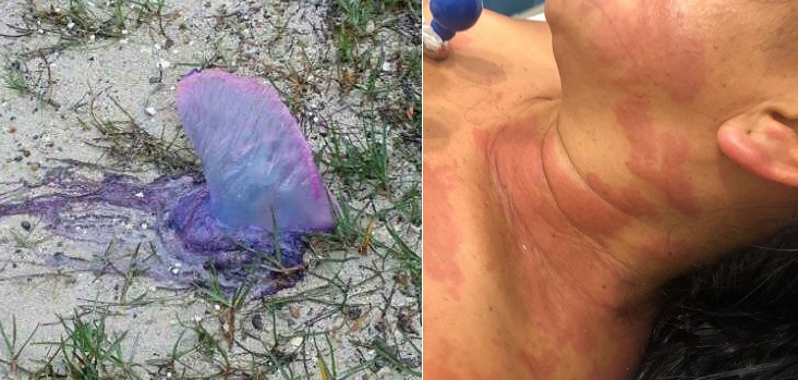 Medusas pican a surfistas en playa de Boca Chica