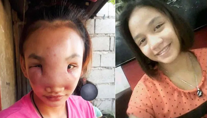Joven se exprimió una espinilla y le afectó el rostro