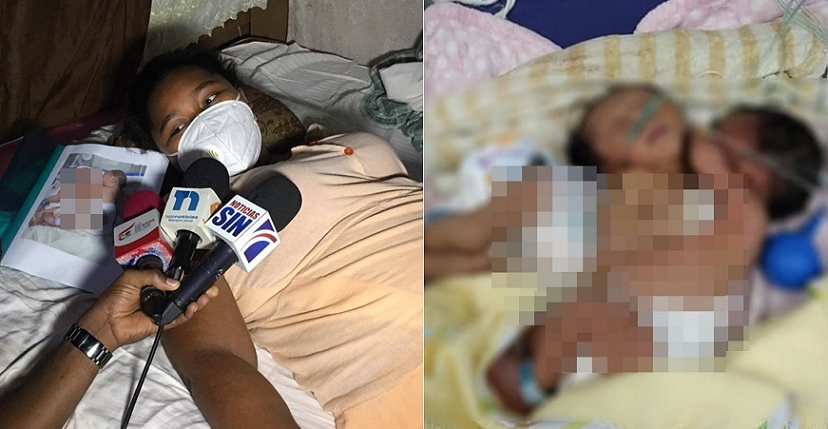 Dio a luz a siameses y pide ayuda en San Juan de la Maguana