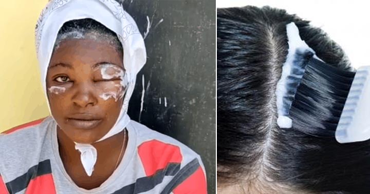 Mujer se aplica un tinte en el cabello y se le desfiguró el rostro