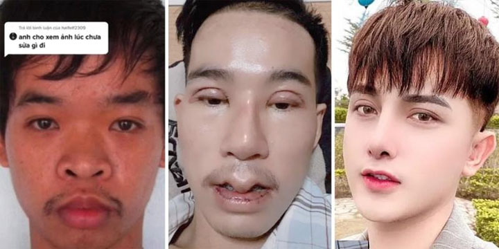 Joven se hizo 9 cirugías faciales para encontrar trabajo. Lo rechazaban porque su cara era “fea