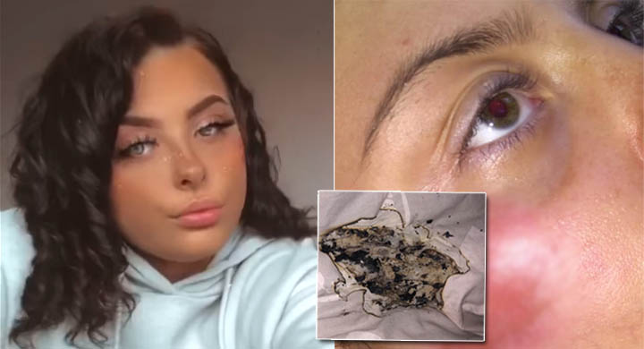 Explota cargador de iPhone y quema la cara de una joven