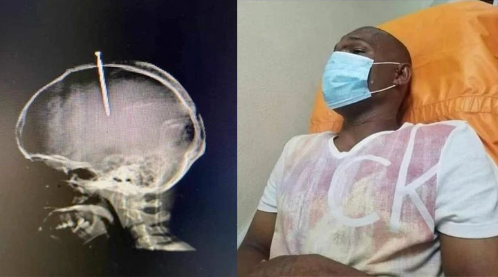 Muere joven que se clavó un clavo en la cabeza