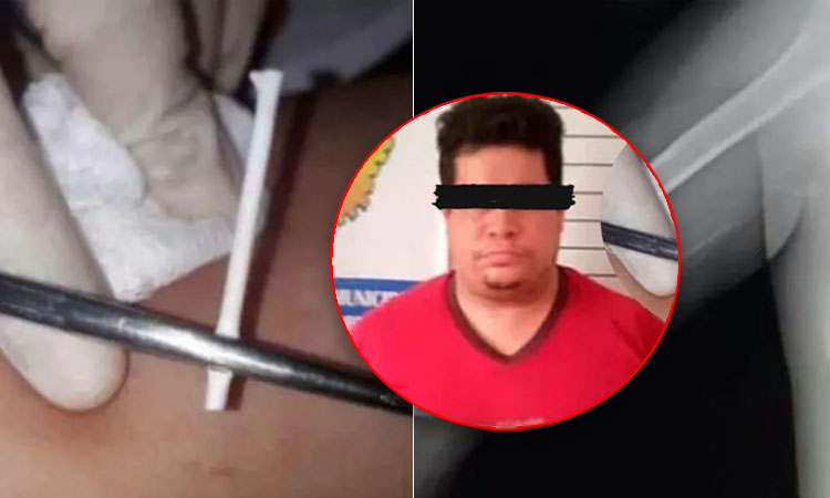 Arrestan falso ginecólogo ponía palitos de bolones como método anticonceptivo