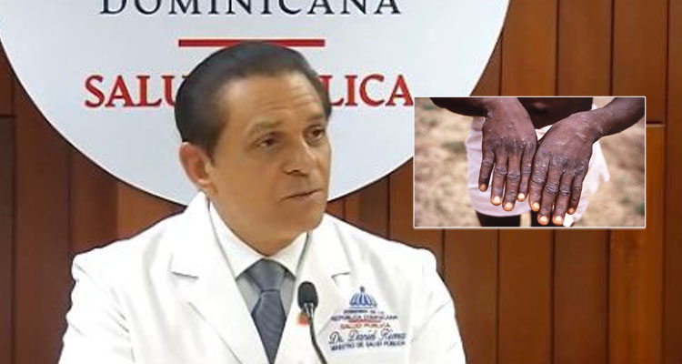 Ministerio de Salud Pública confirma primer caso de viruela del mono en el país