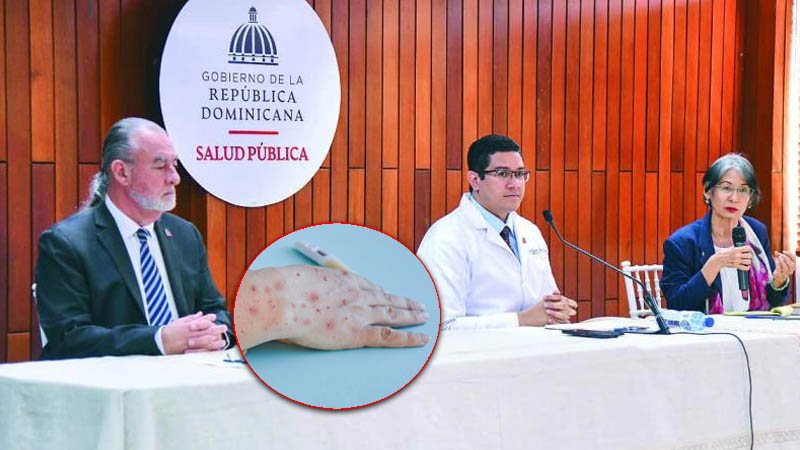 Viruela del mono en RD sigue en ascenso, ya son 18 casos