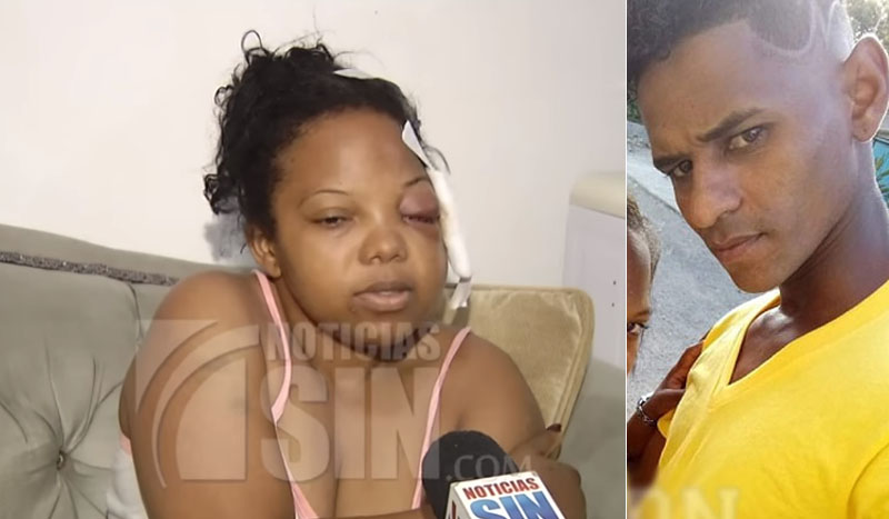Mujer pide justicia tras del golpeada por su expareja en los Alcarrizos