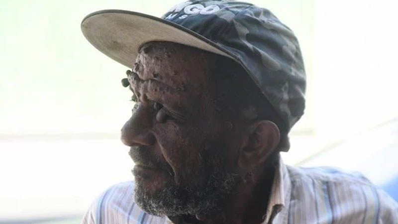 “No tuve hijos para que no salieran como yo”; Papo el hombre de las verrugas