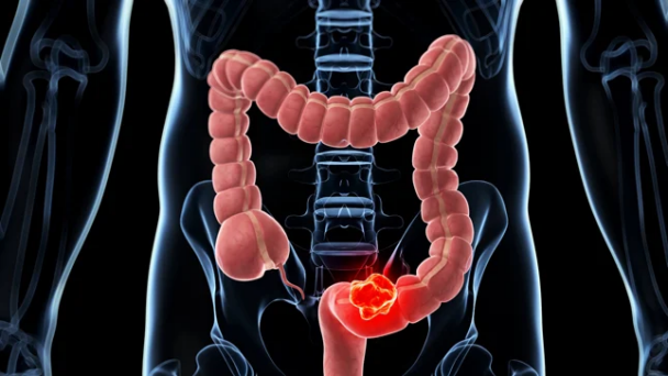Cancer-de-colon-en-jovenes-608x342.png