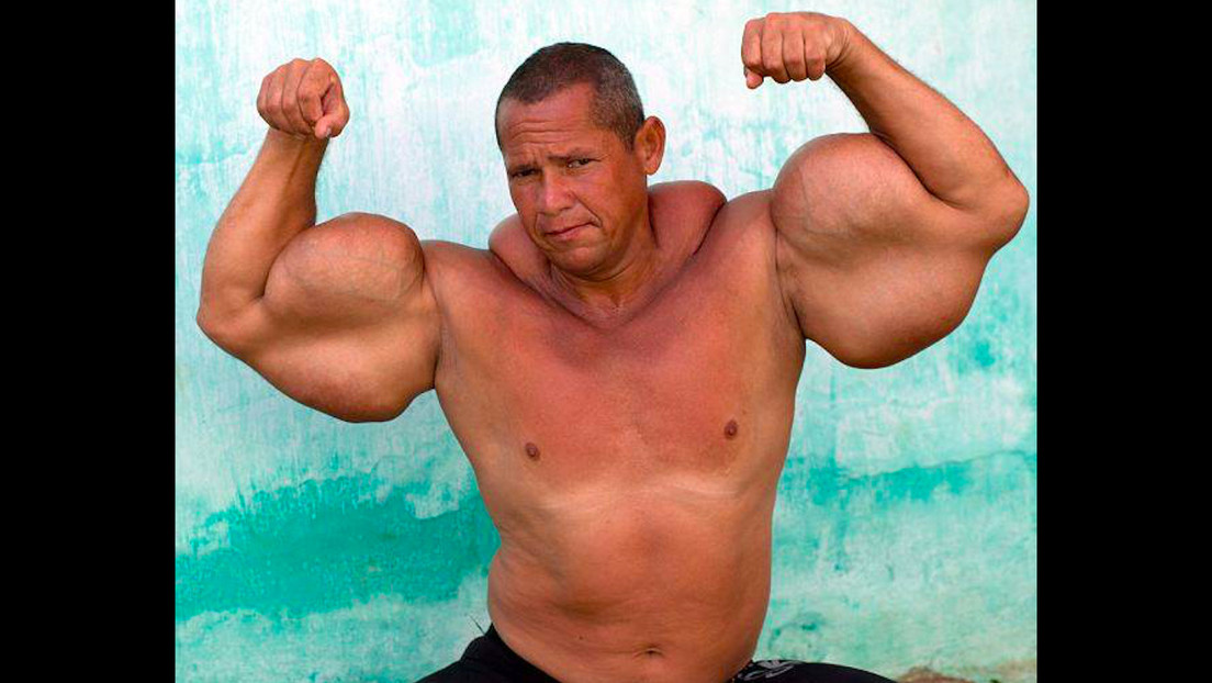 Muere el 'Popeye brasileño', conocido por inyectarse aceite