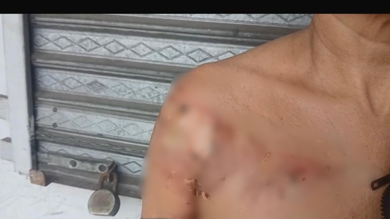 Mujer resulta con graves quemaduras tras ser atacada en Moca