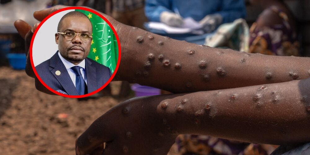 El Congo declara el fin de la viruela del mono