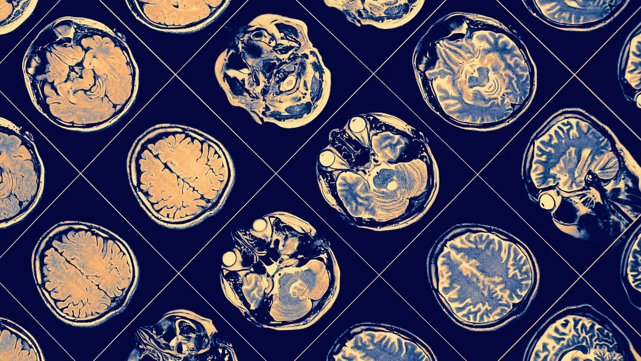 8 hábitos sencillos que reducen el riesgo de Alzheimer y otras formas demencia, según estudios recientes