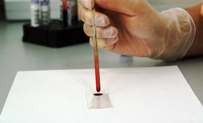 Estudio revela análisis de sangre que mejora la detección