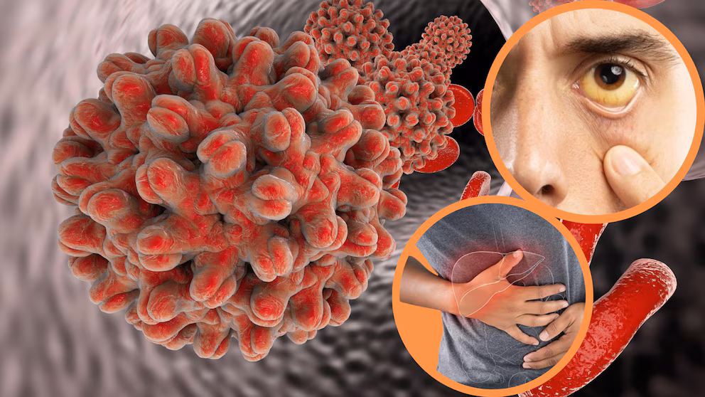 Costa Rica confirma 14 casos de hepatitis A y contaminación en sistema de agua