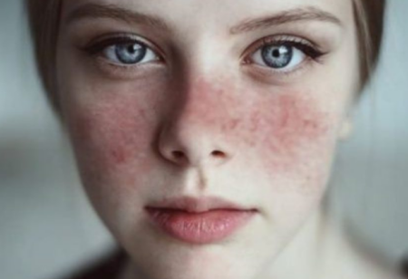 Lupus eritematoso sistémico: síntomas, diagnóstico y tratamiento