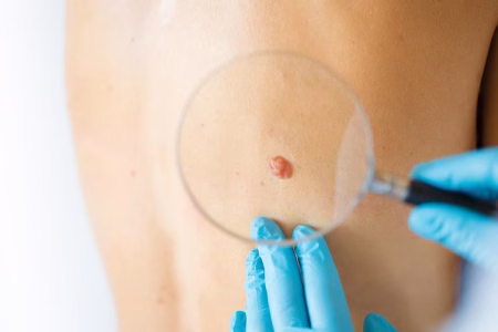 Vacuna contra el cáncer podría mejorar la supervivencia al melanoma, según ensayo